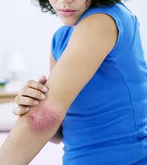 Homeopathic Treatment for Psoriasis