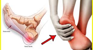 homeopathic remedy for heel pain