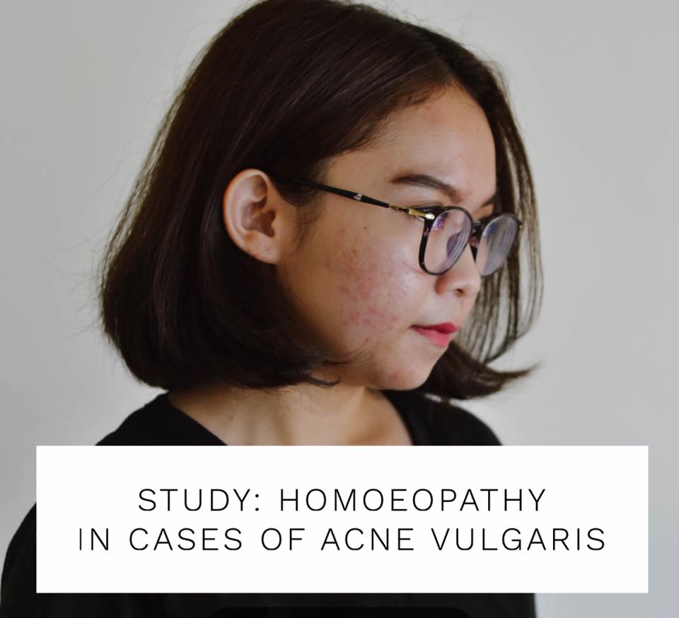 Efficacy of Homeopathic Medicines in the treatment of Acne Vulgaris