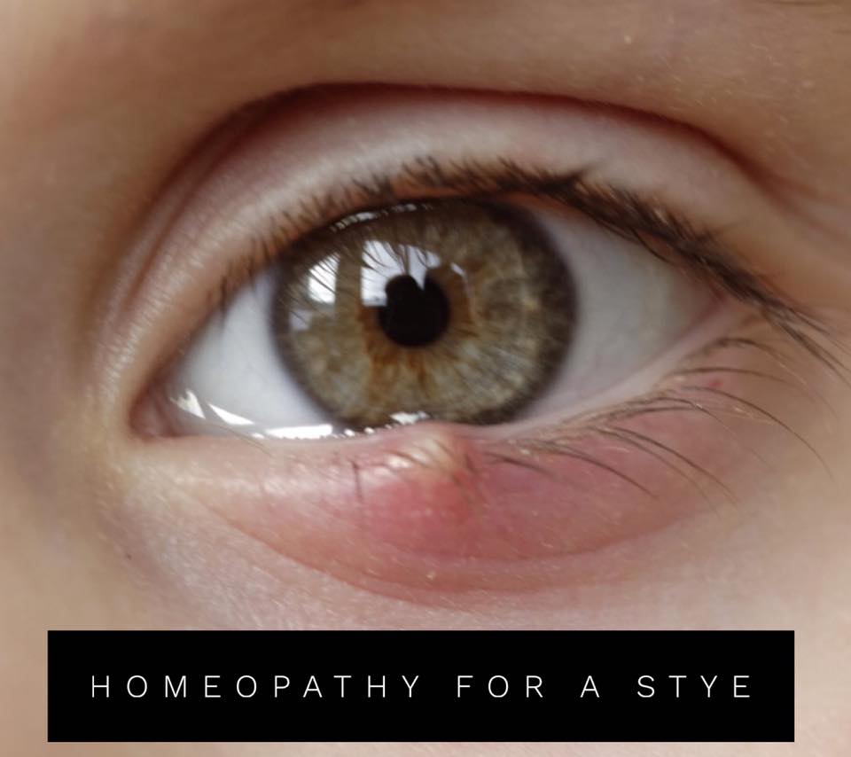 Helpful Remedies for the Stye