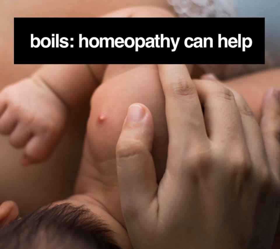 Treat boils with Homeopathic Remedies.